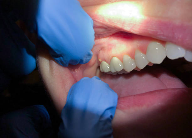Best Broken or Cracked Tooth Emergency Dentist in Tunkhannock, PA